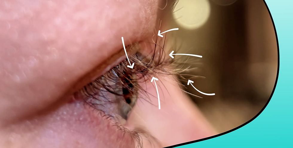 Résultat de la repousse après une lamination coréenne