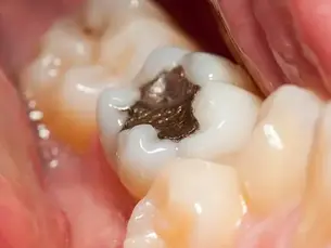 Fogászati tömőanyagok típusai-Melyik a legjobb választás?