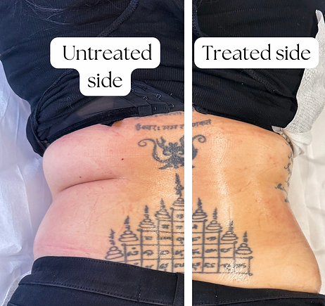 womans back after lymphatic drainage