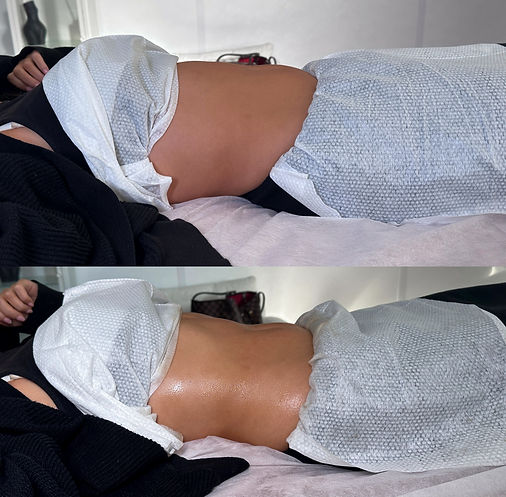 Before and after result on our Essex post-op massage training course