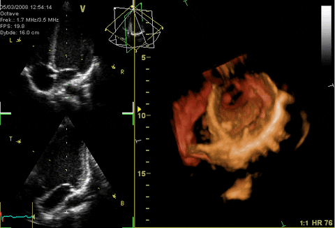 echocardiogram.gif
