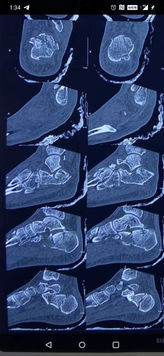 Complex Trauma&fracture.jpeg