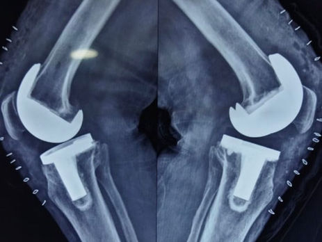 Ilizarov and Deformity correction surgery.jpeg