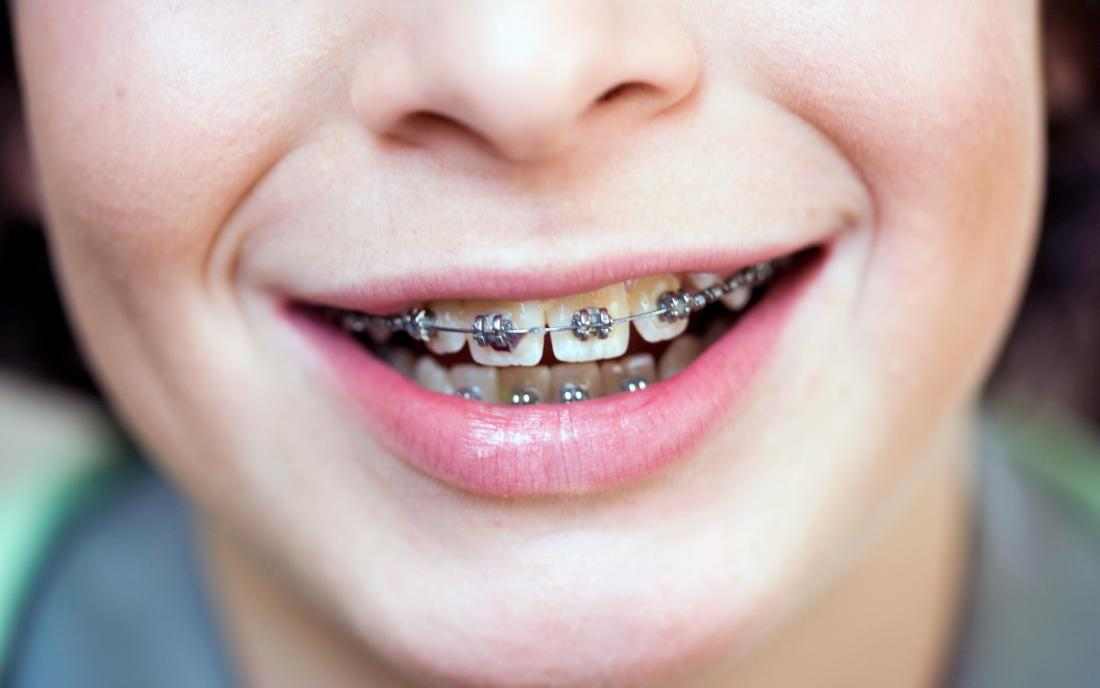 Metal braces treatment