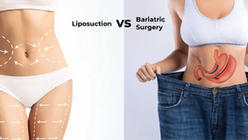 Liposuction vs.bariatric Surgery: What’s the Difference?