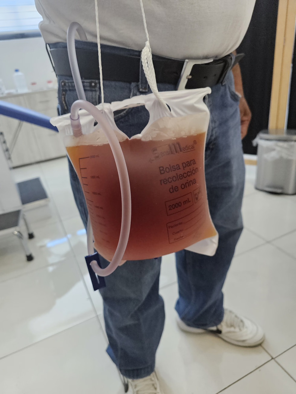 Bolsa médica para recolección de orina con líquido rojizo colgando del cinturón de una persona en una sala clínica.