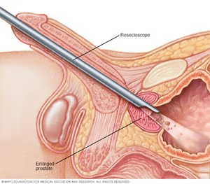 Ilustración médica de un resectoscopio entrando por la uretra para tratar una próstata agrandada.