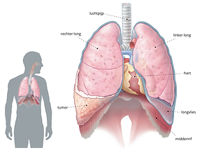 Asbestose