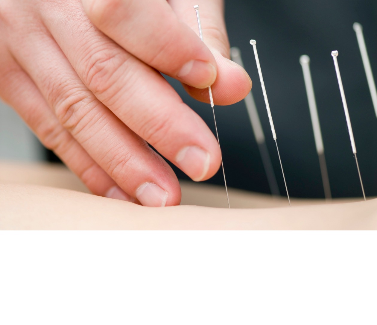 Acupuntura