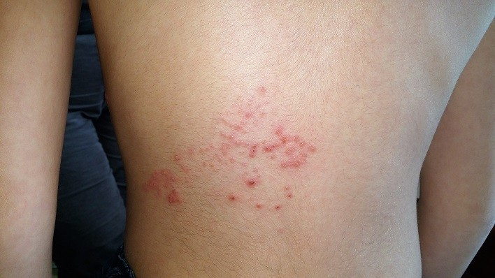 Massage Polarité et Réflexologie Plantaire Holistique pour le zona - séance de détente et soutien nerveux.