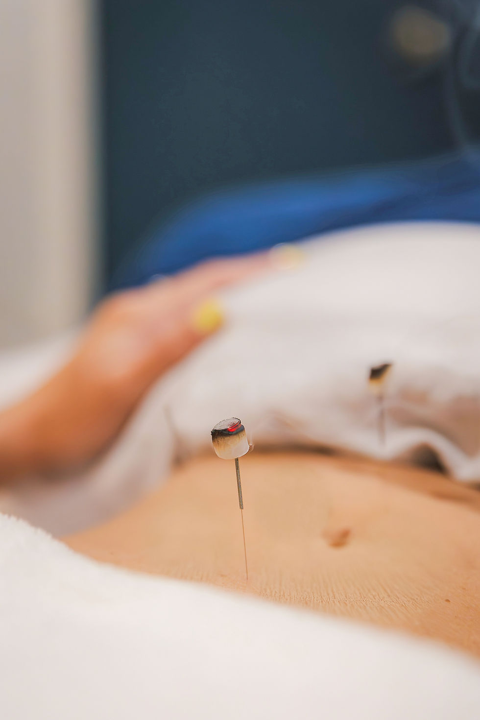 Dr. Holly Durning & Associates acupuncture in St. Petersburg. Close-up of an acupuncture needle in skin with a blurred hand nearby, suggesting a calm treatment session for digestion.
