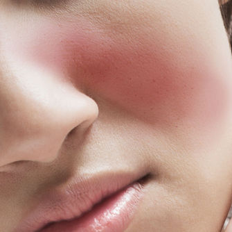 Lúpus Eritematoso Sistêmico (LES)