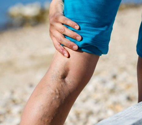 Venas varicosas Parte III