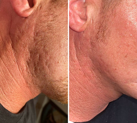 RF Microneedling for Acne Scarring before & after