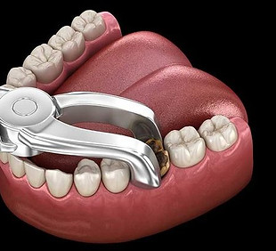 How To Stop Bleeding After Tooth Extraction.jfif