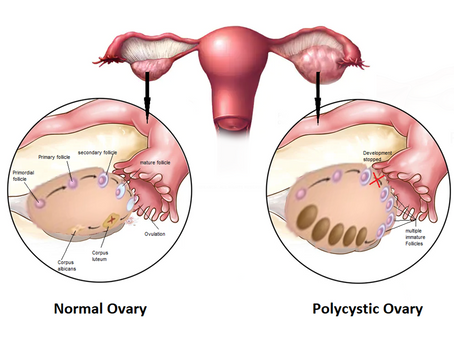 Qu'est-ce que le SOPK (syndrome des ovaires polykystiques)? 