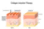 A photo showing how mico-needling works in the skin.
