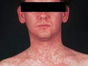 man with measles