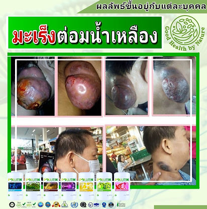 รักษามะเร็ง