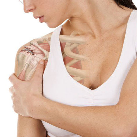 Ombros: quais as lesões mais comuns e como identificá-las