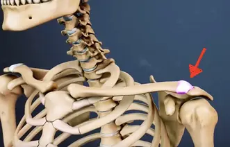 Artrite Acromioclavicular: o que é, sintomas e tratamentos