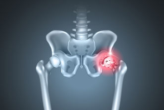 Gerenciando a dor da artrite com exercícios