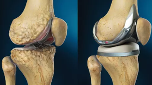 entenda a artroplastia total do joelho