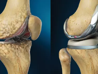 entenda a artroplastia total do joelho