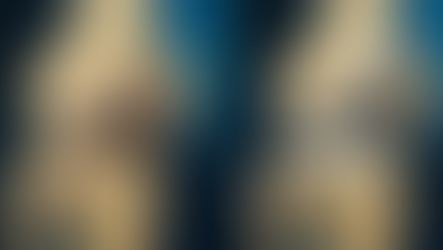 entenda a artroplastia total do joelho