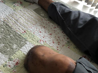 Fisioterapia para amputados