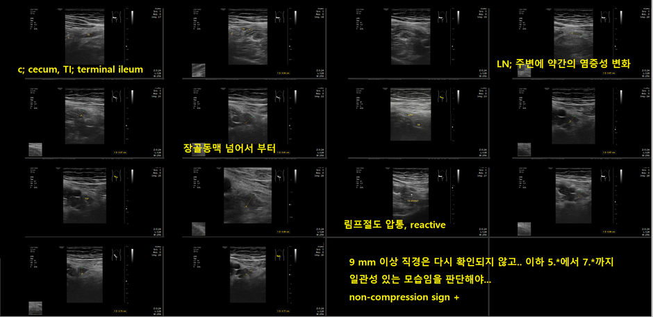 1. 우하복부 압통 +, 정상 충수돌기 vs. 2. 우하복부 압통 +-?, 확장되고 눌리지 않는 충수돌기; 1은 투약, 2는 외과 이차의견 의뢰 - 동대문구 답십리, 우리안애 내과
