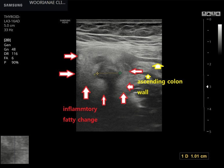 과거 게실염 기왕력 환자의 복통 평가, 초음파상 전형적인 게실염 확인