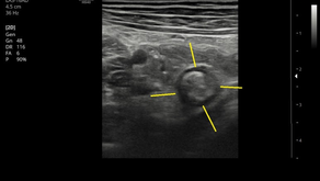 발열로만 왔는데/복통도 없이!...설사없는 장염 및 림프절염... 왼쪽의 림프절염은 처음; 검사 권유가 사기꾼처럼 들리는 상황 - 동대문구 답십리, 전농동, 우리안애 우리안愛 내과