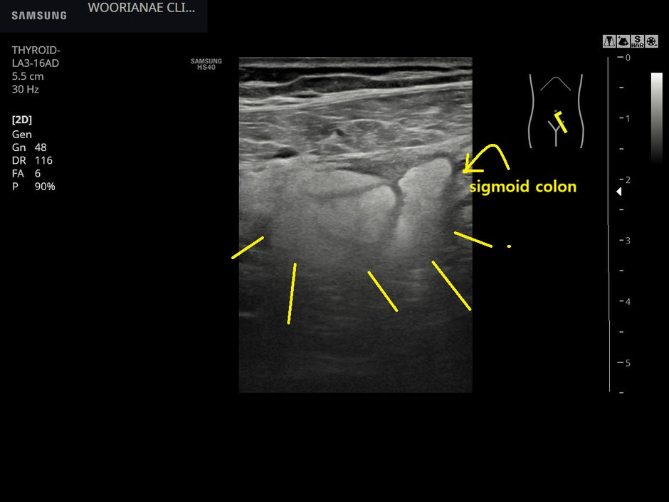 왼쪽 골반에서 오른쪽으로 파급된? 게실염?; 소장점막의 비후, 장간막 지방염증 및 염증성 복수, 정상 충수의 확인 - 동대문구 답십리, 전농동, 우리안애 우리안愛 내과