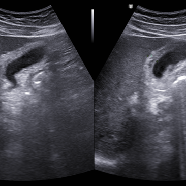 복부, 담낭초음파; 급성 A형 간염에 의한 변화