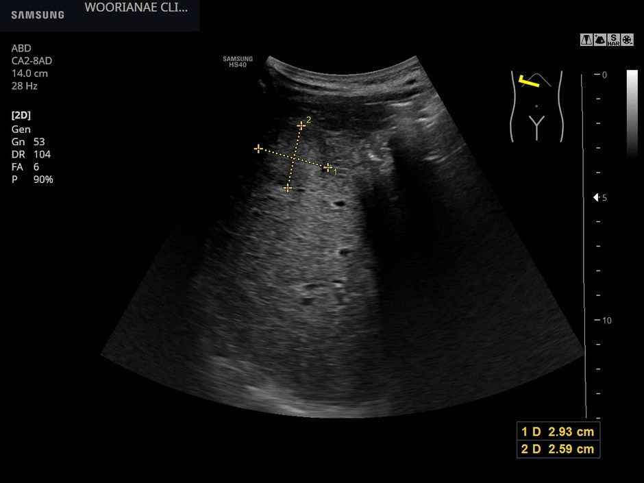 과거 알코올 남용자로서 rGTP의 상승에 대한 간초음파, 기대하지 않았으나 거친 간실질 배경에 간종괴 - 동대문구 답십리, 장안동, 우리안애 우리안愛 내과 