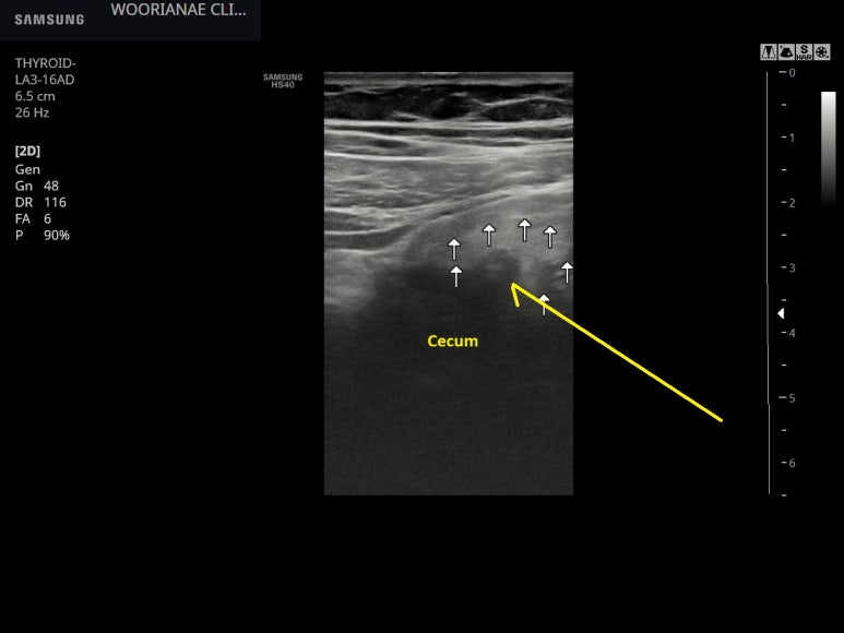 같은날 게실염 (1); 2년만에, 컨벡스로는 잘 보이지 않음, 리니어 프로브로 확인 - 동대문구 답십리, 전농동, 우리안애 우리안愛 내과