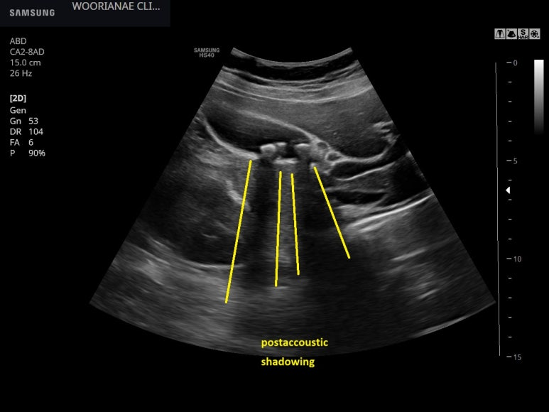 담도/담낭 산통 정도로 기술하지 않으나... 정도가 약한 특이한 식후 증상의 기술 - 동대문구 답십리, 전농동, 우리안 우리안愛 내과