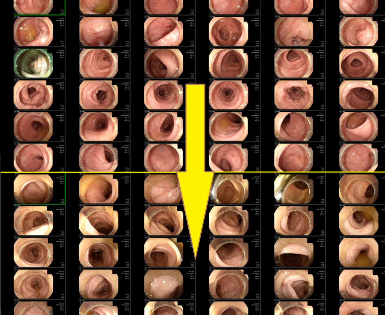 궤양성 대장염, 범결장염 환자의 내시경 추적, 증상은 다시 있으나? 내시경적 관해 소견 - 동대문구 답십리, 전농동, 우리안애 우리안愛 내과