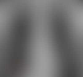 과거 결핵에 의한 원형 흉막 석회화 소견