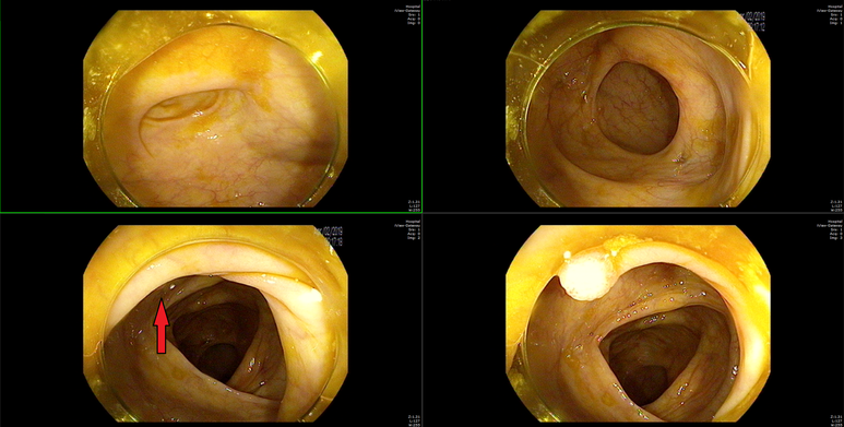 대장의 팽대 (haustra) 뒤쪽 용종의 발견, 순간 동체 시야의 중요성