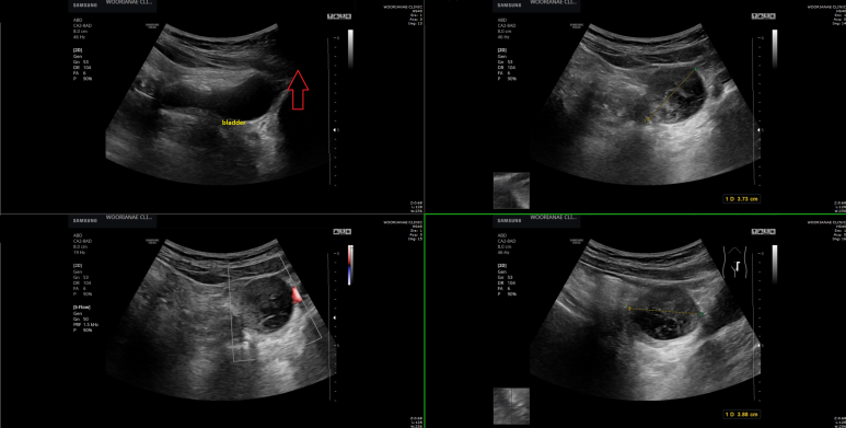 구토 후 지속되는 소화불량, 우연히 발견된 왼쪽 난소 종괴 의증, 소장 종괴? 가능성은?