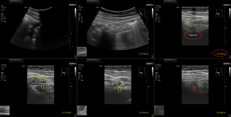 "심하게 가스찬다." 팽만감 과 이곳저곳 복통, 그러나 우하복부 압통, 림프절염? 충수돌기염? 약제치료 후 추적 계획