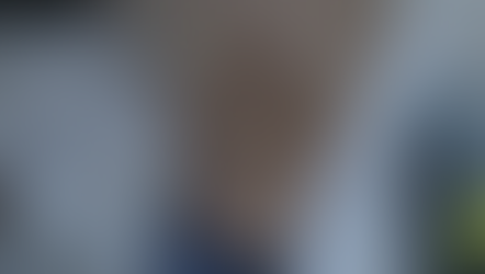 탈모성지에서 1년처방?? 미녹시딜 부종/체중증가를 강하게 의심 - 동대문구 답십리, 신대방동, 우리안애 우리안愛 내과