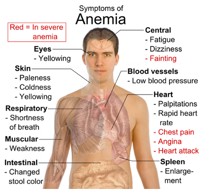 악화된 협심증 증상사례; 빈혈 --> 재생불량성빈혈/골수이형성증후군? 의증으로 골수검사 예정 --> 급성골수성백혈병