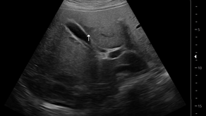 복부, 간 초음파; 비만 환아에서의 초음파상 간의 국소성 지방결여, focal fat sparing of the liver