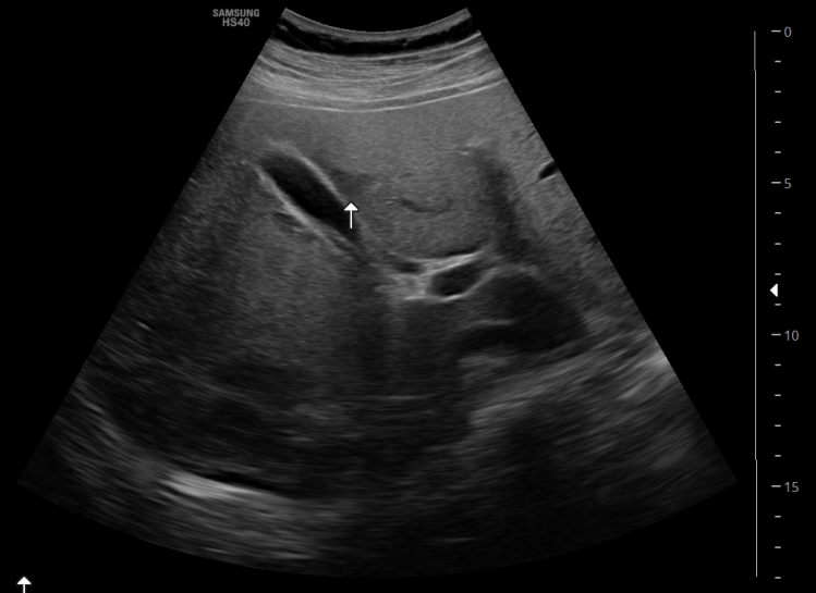 복부, 간 초음파; 비만 환아에서의 초음파상 간의 국소성 지방결여, focal fat sparing of the liver