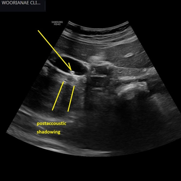 실신 직전을 야기할 정도의 복통?? 대학병원 응급실, 여러 의원을 거쳐... 최초 모습은 담도폐쇄 간병증 - 동대문구 답십리, 신천동, 우리안애 우리안愛 내과