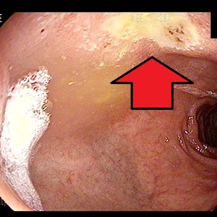 아마도 전정부에 국한되었던 헬리코박터 감염의 진행 혹은 그 사이 감염 - 동대문구 답십리, 용답동, 우리안애 우리안愛 내과