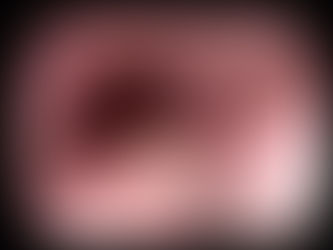 상복부 증상 평가에서 관련없이 우연히 발견된 식도과립세포종, granular cell tumor - 동대문구 답십리, 용신동, 우리안애 우리안愛 내과